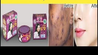 100% ምርጥ ማድያትን የሚያጠፋ ክሬምfaiza(faiza best melasma cream)