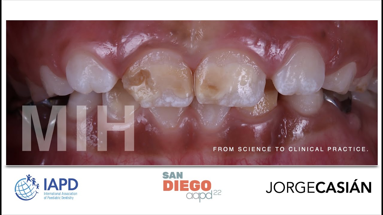 Molar Incisor Hypomineralization. Diagnosis Criteria of EAPD for MIH