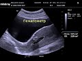 Нажмите для просмотра : Несостоятельность послеоперационного шва матки