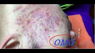 ACNE TREATMENT FOR Mạnh part 4 (64) | Loan Nguyen