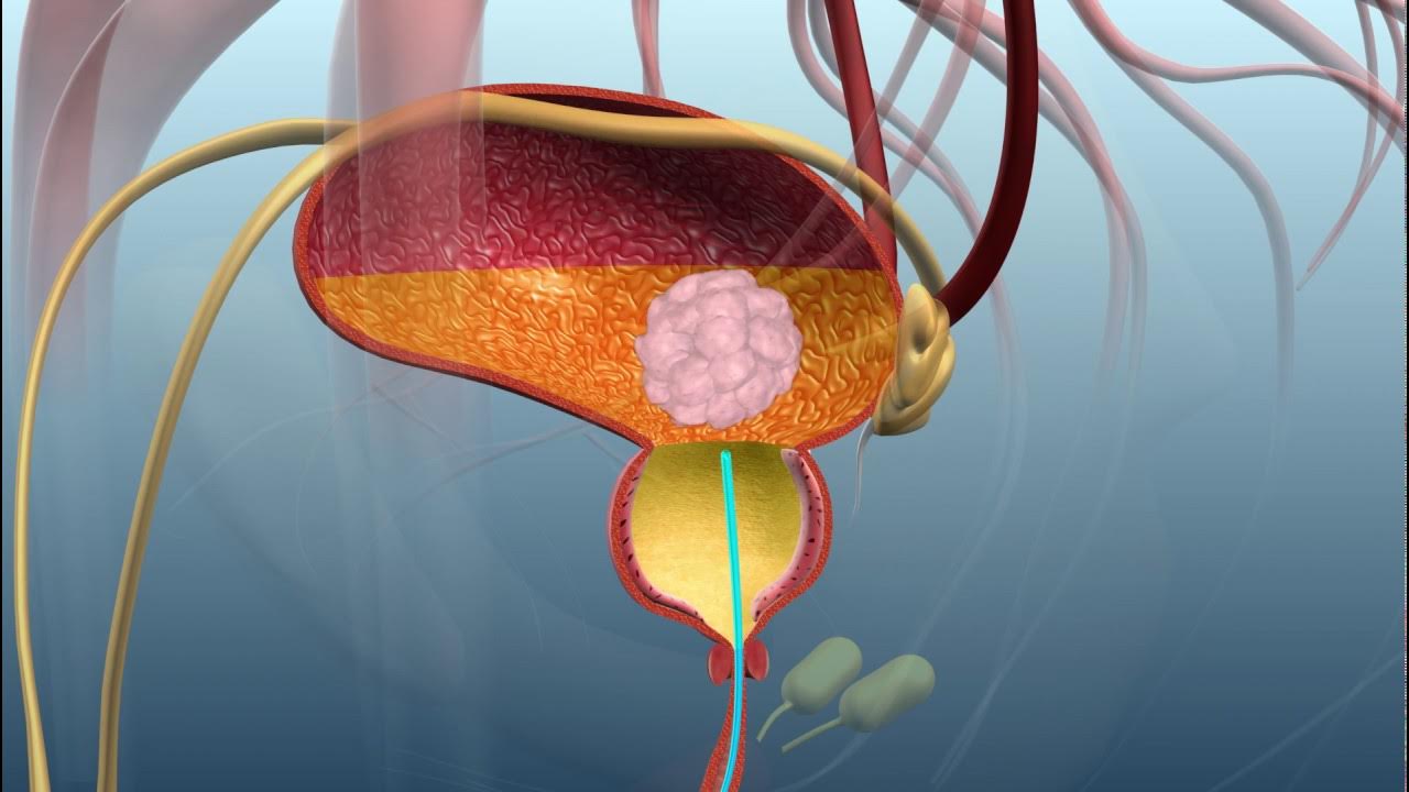 Résection transurétrale par laser Soins minimement invasifs pour troubles de la prostate
