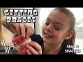 Whitney is Getting Braces! | Step 1 Spacers