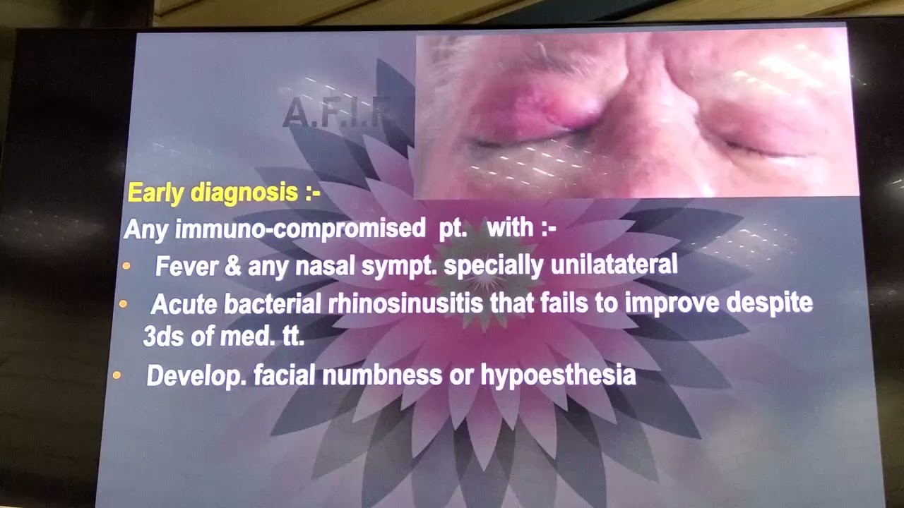 ا.د صادق زاهر Fungal sinusitis من محاضرات القصر العيني 