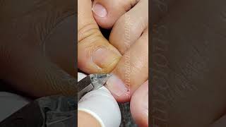small toe dryskin removal