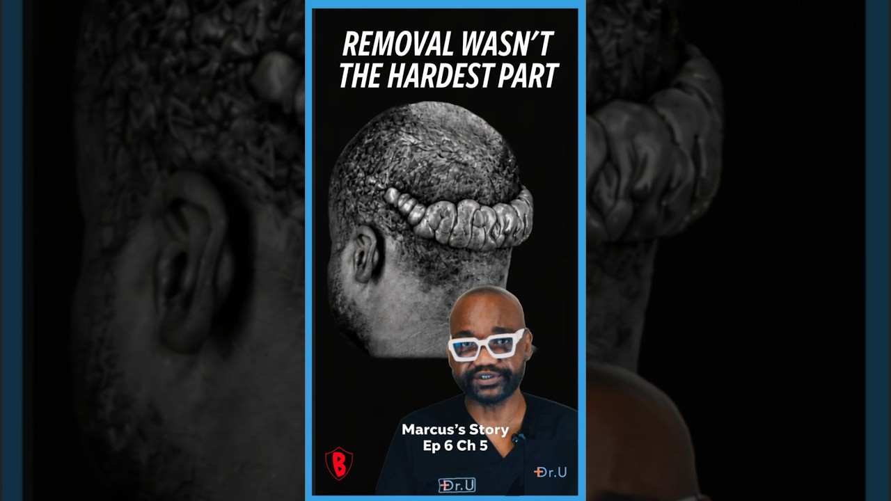 Severe Keloid Removal Surgery: Why Surgeons Hesitate