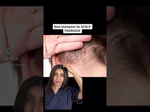 Video: Are psoriazis pe scalp?