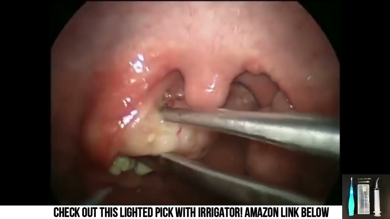 Tonsil Stone Facts, Bonus Teeth Pens