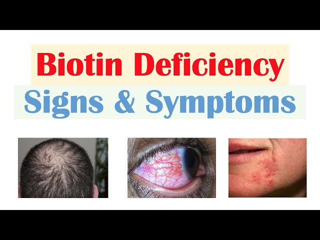 Gulf View Medical Centre - Biotin Deficiency Involves Abnormalities of the  Hair, Skin, Nails & the Central Nervous System – Learn more about Symptoms,  Causes, Treatment & Prevention. What is Biotin? B