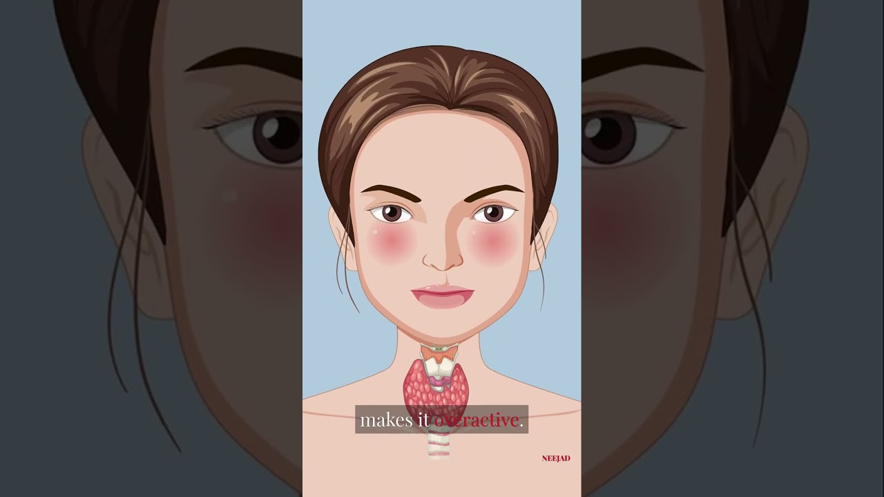 Parathyroid Disorders - Layman Medicine