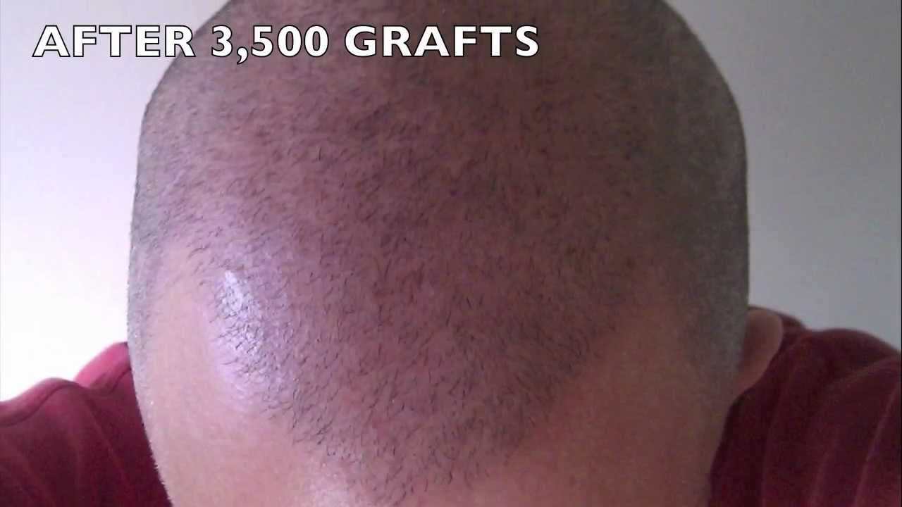 3500 Graft BHT Body Hair Transplant Result Video By Dr Woods