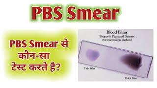 PBS slide | Periferal blood smear | PBS test