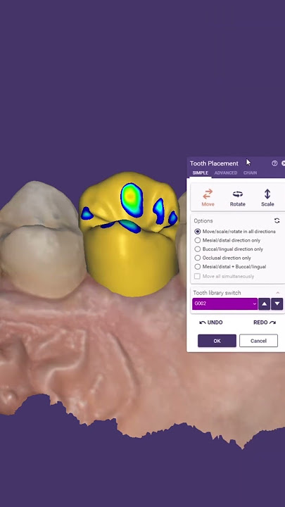 exo #exocad #anatomy #dentalcaddesign #exo #dentist #smiledesigndental #duet #shrots #orthodontist