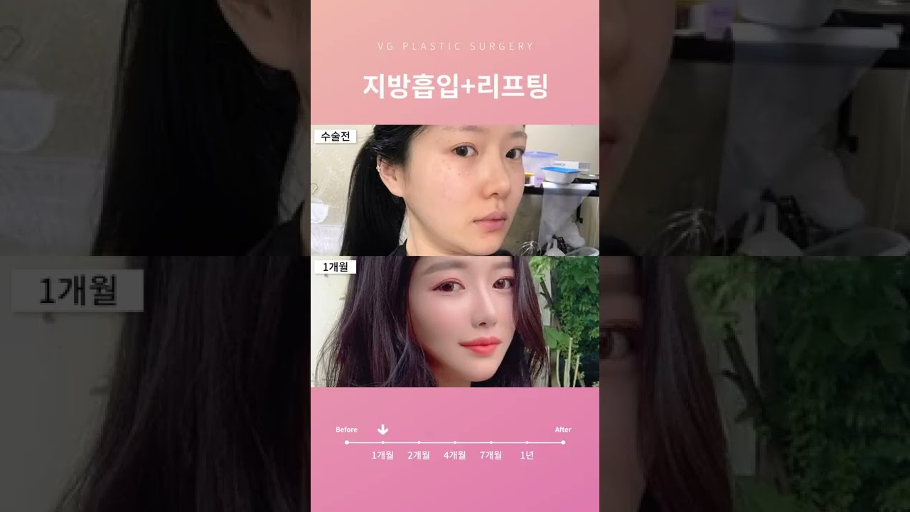 [БЭРИГУУДЫН ГОО САЙХНЫ МЭС ЗАСЛЫН ЭМНЭЛЭГ] #БЭРИГУУДЫНГООСАЙХНЫМЭСЗАСАЛ Биний хүссэн гөлгөр V шугам БЭРИГУУД-ээр гүйцэлдүүлцгээе 😁💖БЭРИГУУДЫН ГОО САЙХНЫ МЭС ЗАСЛЫН ЭМНЭЛЭГ