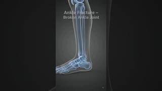Ankle Fracture Explained | Causes, Anatomy & Bone Break in Ankle Joint #science #facts #usa #sports