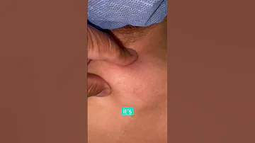 HUGE LIPOMA REMOVAL DR TANVEER JANJUA NEW JERSEY 