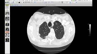 STR Cardiothoracic Case Webinar 3/8/2018