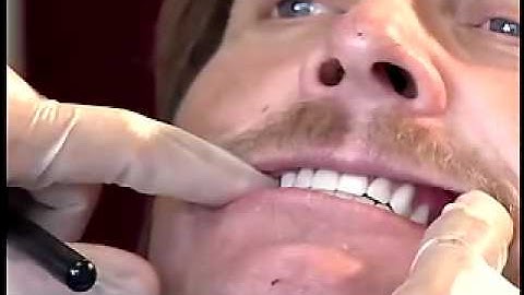 19 www.4dent.net - Wax Trial Insertion