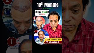 10 Months Hair Transplant Result | Patient Is Very Happy With His New Look! #hairtransformation