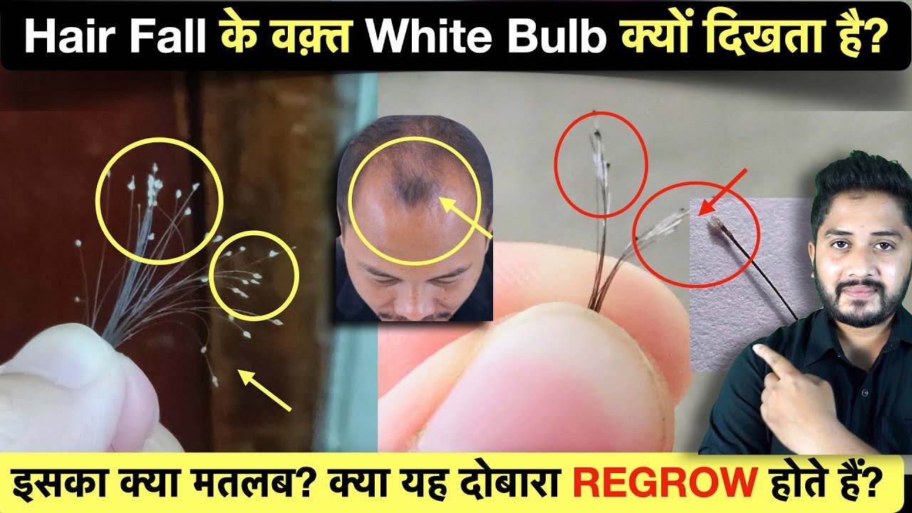 Hair Fall के वक़्त White Bulb क्यों दिखता है? Hair Fall with White Bulb at the end.