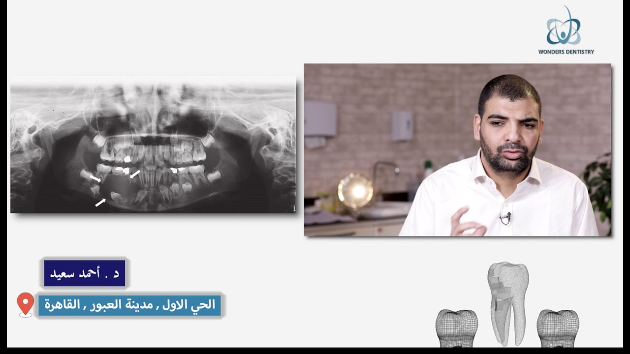 اسباب فقدان عظم الفك قبل زراعة الأسنان