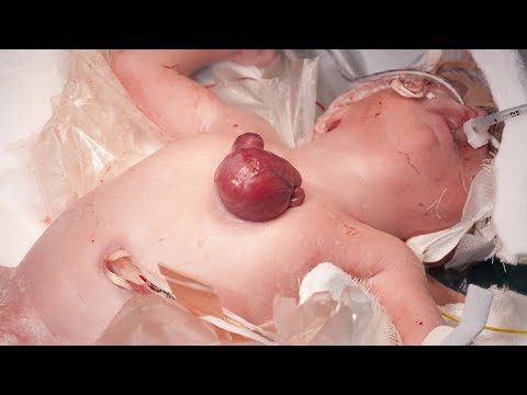 Successful surgery for U.K. baby born with heart outside her body
