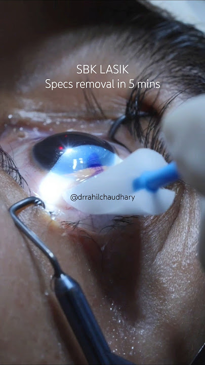 LASIK Laser eye surgery #lasik #lasiklaser #lasikeyesurgery