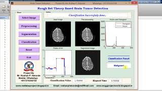 Brain Tumor detection using Rough Set theory Matlab Project Code - IEEE Project