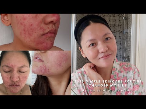 Видео: Как My Rosy Rosacea Flare-Ups поддържат кожата ми светеща