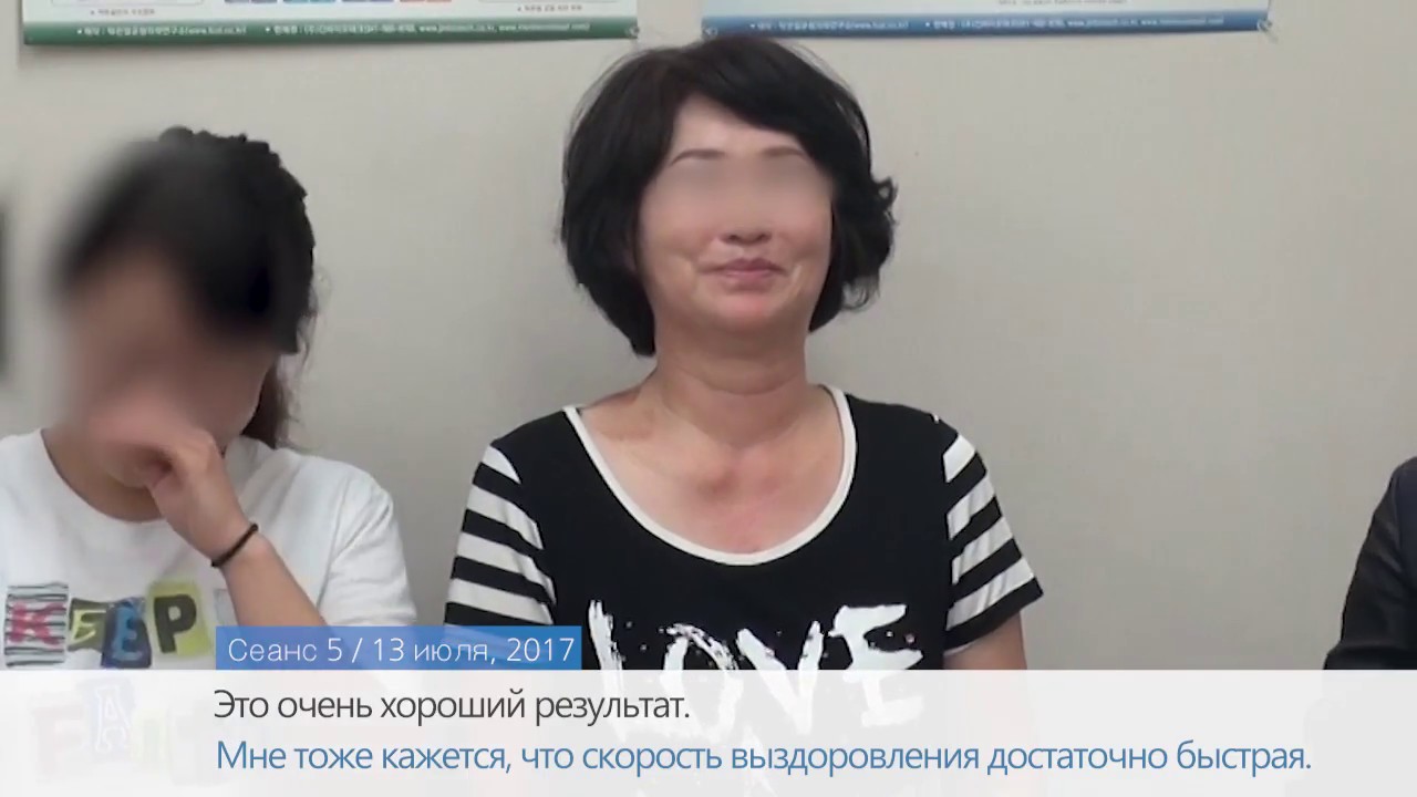 Спастическая кривошея / Пример лечения Дистония - YouTube