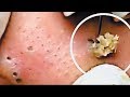 Worst case  remove nose blackheads