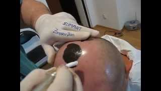 Micropigmentare scalp Artist Zarescu Dan ZDM clinica SlimArt roller 56 ace Oron57