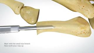 PROstep MIS Bunionette Surgical Animation