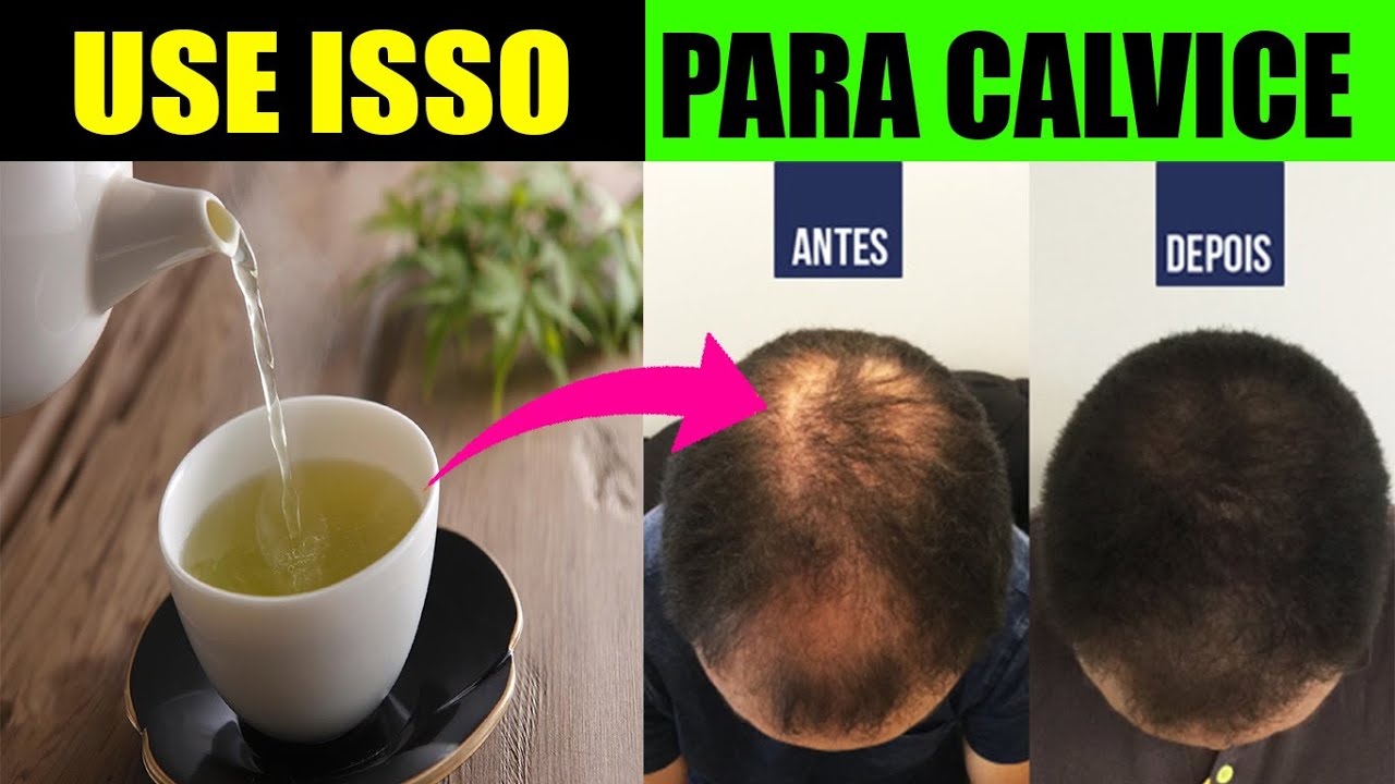 ESSE PODEROSO CH Combate A CALVICE MASCULINA E A QUEDA DE CABELO COMO 