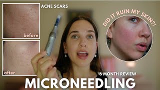 Celebrity Dr Pen M8S Microneedling Results After 6 Months: Worth It or Not? 😅 Net Worth