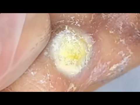 Remove the corn from the joint of the foot!