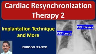 Cardiac Resynchronization Therapy - Implantation Technique and CRT Implantation Pearls from Experts