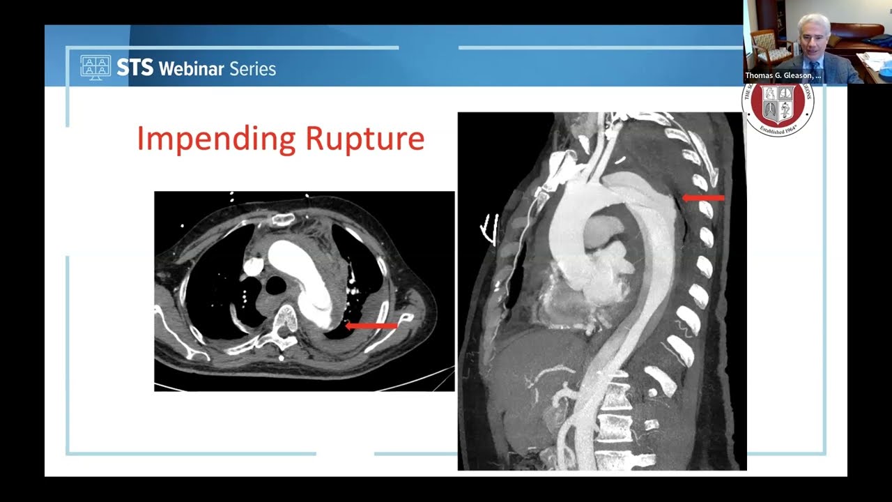 Management of Type B Aortic Dissection Takeaways from the STS/AATS
