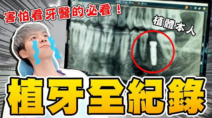 怕看牙医的必看！玮玮植牙全记录，在牙齿里钻螺丝孔？！【黄氏兄弟】植牙、全瓷冠 Ft.悦庭牙医诊所 - 天天要闻