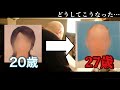 若ハゲになるまでを振り返った