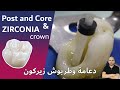 FIBER POST & CORE filling after Root Canal and ZIRCONIA dental crown cementation