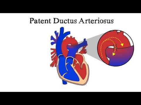 Patent Ductus Arteriosus (PDA)