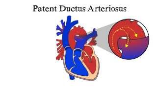 Patent Ductus Arteriosus Pda