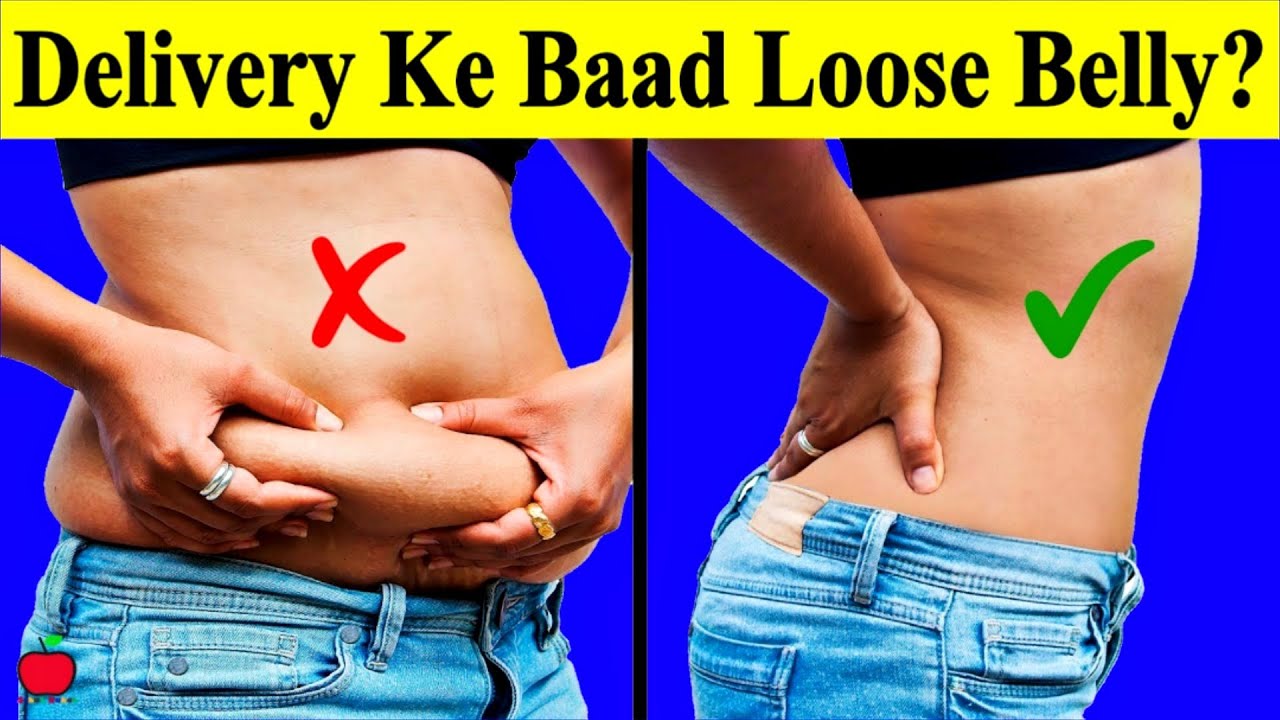 Delivery Ke Baad Loose Belly Ko Tight Kaise Kare Pregnancy Stretch