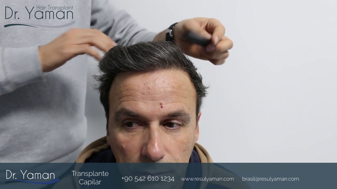 Dr. Yaman Transplante Capilar Resultado