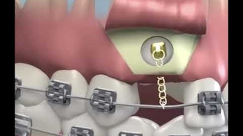 Impacted Canine Treatment