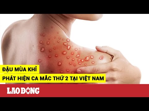 Video Việt Nam phát hiện ca đậu mùa khỉ thứ hai, kịp thời... - youtube