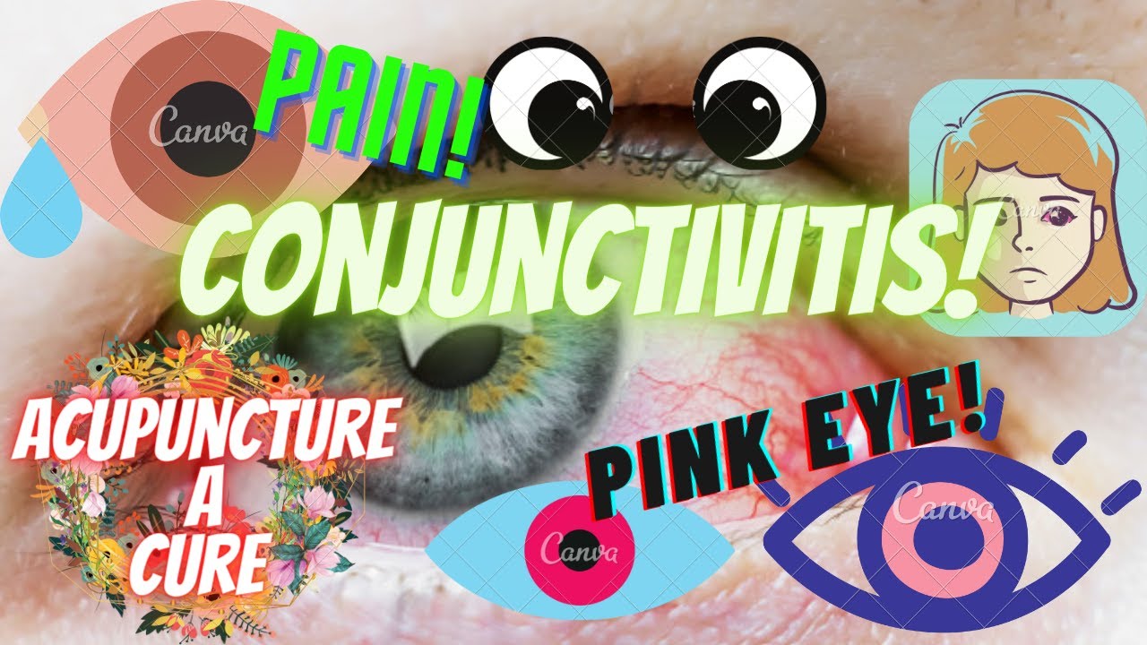 How to treat CONJUNCTIVITIS in the eye treatment home remedies