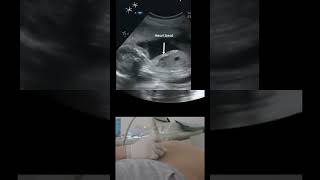 Ultrasound seen Baby  Boy? Baby kicking in mother Womb? Mbbs final year B.sc nursing viral ?????