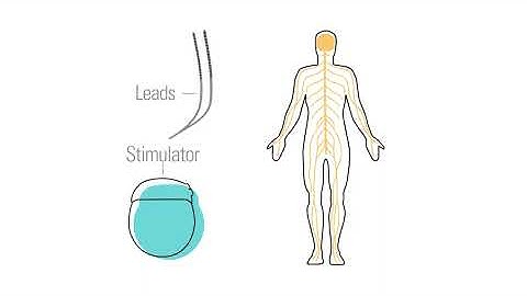 How Spinal Cord Stimulators Works