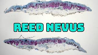 Reed Nevus vs Melanoma: How to Tell Them Apart